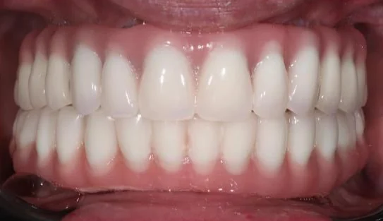 After: full-mouth acrylic All-on-4, upper and lower