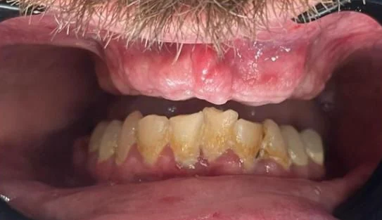Before: full-mouth acrylic All-on-4, upper and lower
