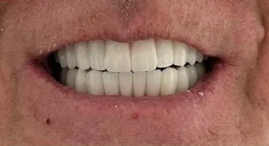 After — All-on-4 real case 1: worn, discolored teeth replaced