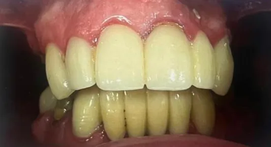 Before — All-on-4 real case 1: worn, discolored teeth replaced