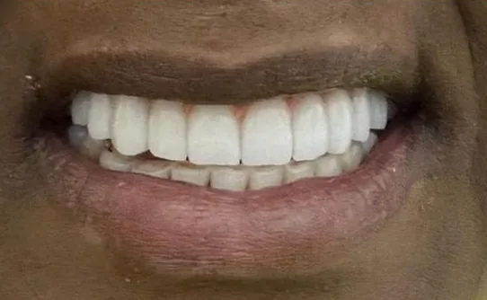 After — All-on-4 real case 2: missing and failing teeth replaced