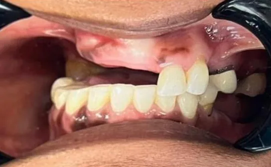 Before — All-on-4 real case 2: missing and failing teeth replaced