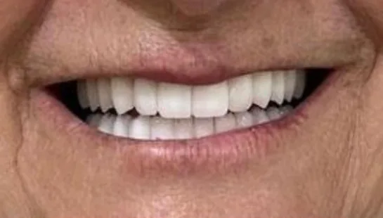 After — All-on-4 real case 3: toothless upper arch restored