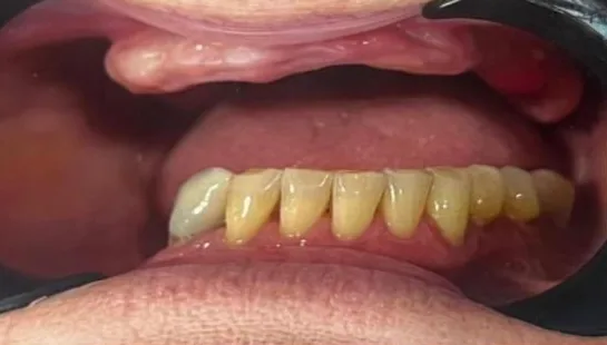 Before — All-on-4 real case 3: toothless upper arch restored