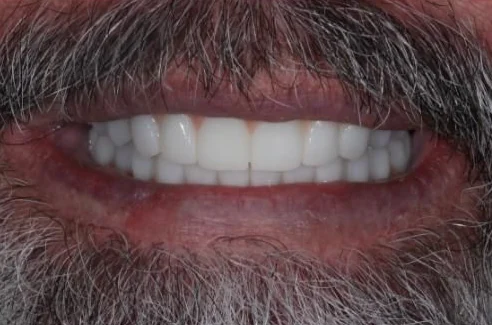 After: full-mouth zirconia All-on-4