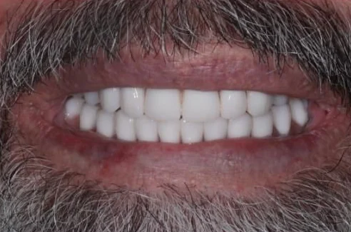 Before: full-mouth zirconia All-on-4