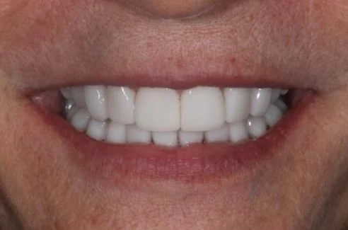 After: combination of crowns and veneers