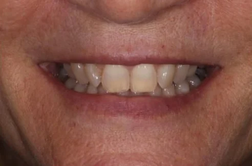 Before: combination of crowns and veneers