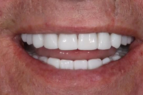 After: full set of zirconia crowns