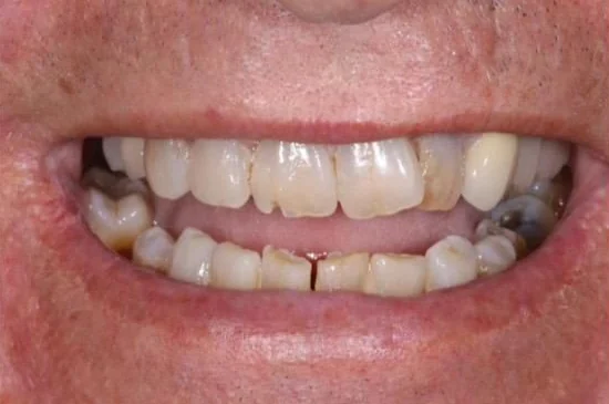 Before: full set of zirconia crowns