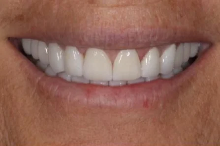 After: full set of porcelain veneers