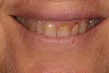 Before: full set of porcelain veneers