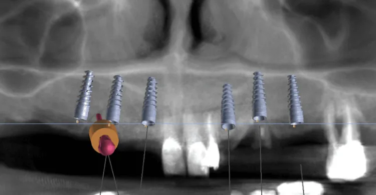 The 3D plan: Each implant’s position, depth and angle is set on the patient’s 3D CT scan.