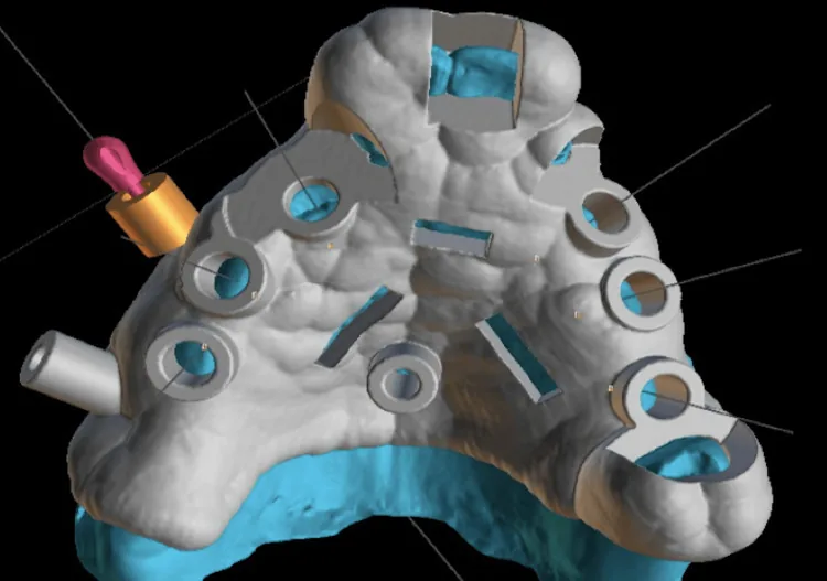 Guide designed on screen: The guide is built around the plan, with a sleeve for every implant.