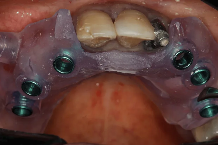Guide seated on the gums: The guide is fixed in place so it cannot move during surgery.