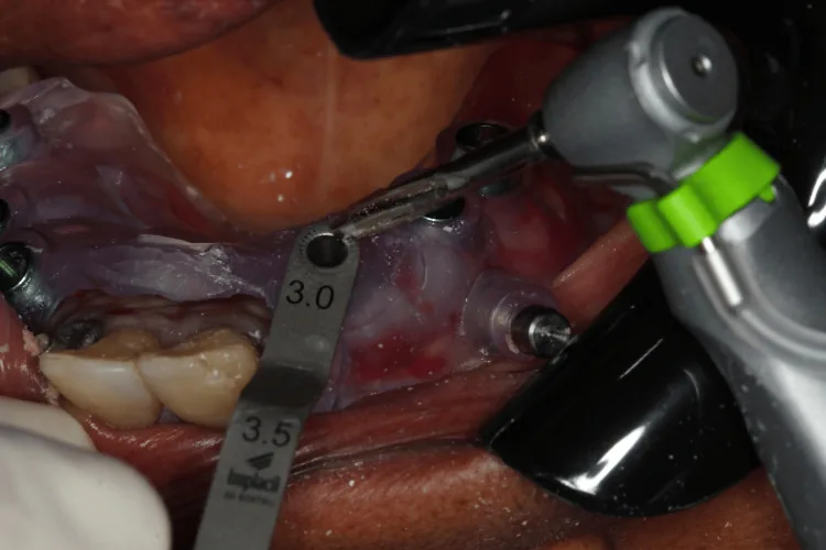 Drilling through the sleeve: The drill can only follow the path that was planned.