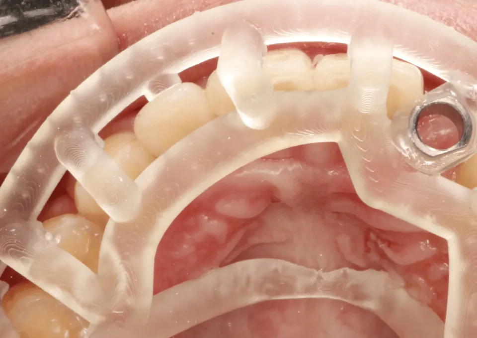 Guide resting on the teeth: For one implant, the guide sits on the neighboring teeth.